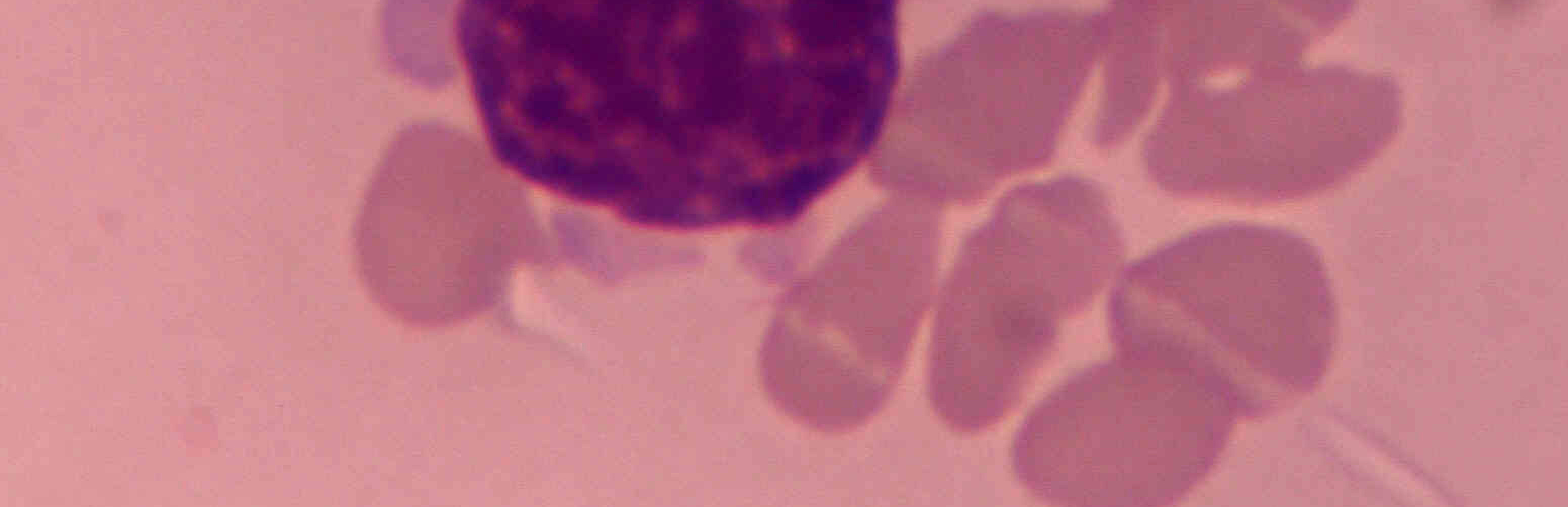 Resultados cuatro casos (1%) que se catalogaron como dudosos, en los que se observaron inclusiones intracitoplasmáticas especialmente en linfocitos y en un caso en células granulocíticas (Imagen 23).
