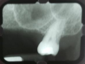 limitaría para la colocación de implantes, en el sector posterior de ambos lados. (figura 3) Figura 2; Radiografía panorámica.
