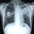 Parénquima Pulmonar Infecciones