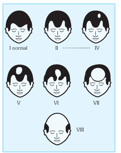 ALOPECIA ANDROGÉNICA Concepto La alopecia androgénica (AGA) es la forma más común de calvicie y es considerada como un proceso fisiológico que afecta a muchos varones y a algunas mujeres.