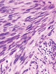 Tumor del estroma gastrointestinal: Se trata de tumores que se originan a partir de células intersticiales de Cajal dentro de la muscular propia.