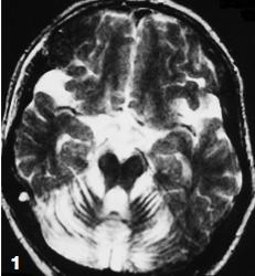 Afectación neurológica Neurológico 64 pacientes con Niemann Pick tipo B 30% alteración neurológica +22%