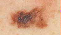 Daños en la piel tan leves como una simple quemadura (eritema solar) o de tal gravedad como mutaciones en el ADN de las células cutáneas que pueden derivar en el cáncer de piel, el cual puede