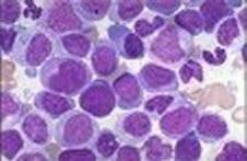 Síndromes Mielodisplásicos (SMD): definición Grupo heterogéneo de enfermedades clonales de células progenitoras hematopoyéticas (CPH) Diferenciación y maduración