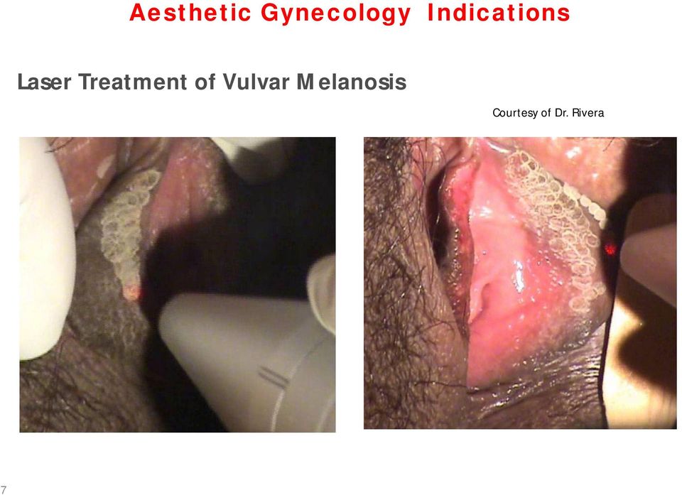 Treatment of Vulvar