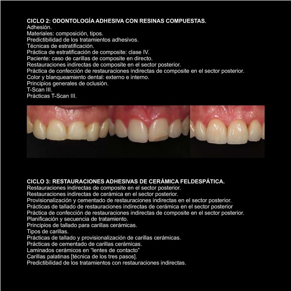 Práctica de confección de restauraciones indirectas de composite en el sector posterior. Color y blanqueamiento dental: externo e interno. Principios generales de oclusión. T-Scan III.