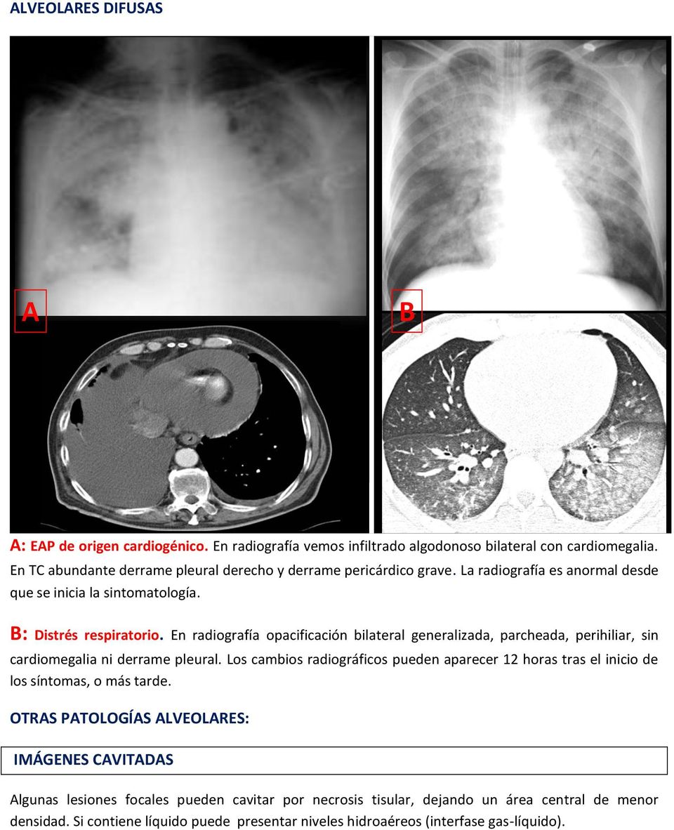 En radiografía opacificación bilateral generalizada, parcheada, perihiliar, sin cardiomegalia ni derrame pleural.