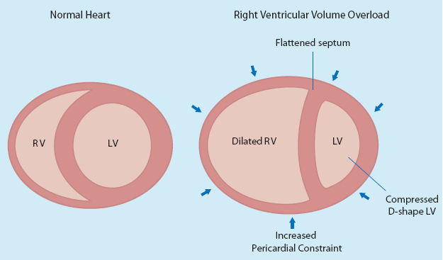 Interdependencia ventricular Dilatación o sobrecarga de presión causa