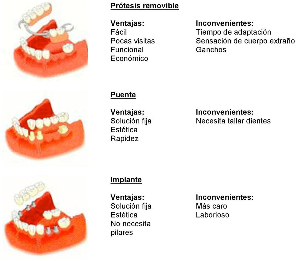 Ventajas: Solución fija Estética Rapidez Inconvenientes: Necesita tallar dientes