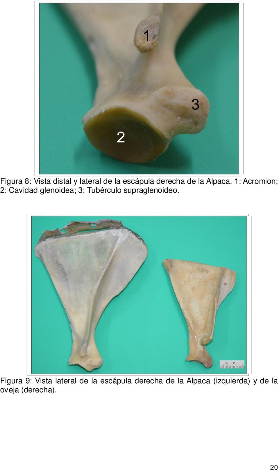 1: Acromion; 2: Cavidad glenoidea; 3: Tubérculo