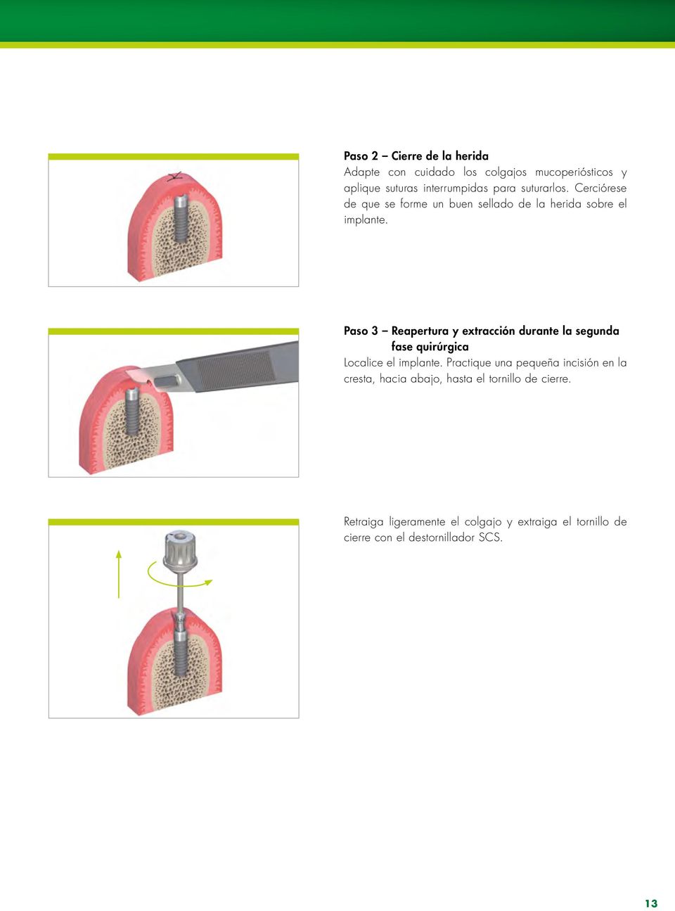Paso 3 Reapertura y extracción durante la segunda fase quirúrgica Localice el implante.