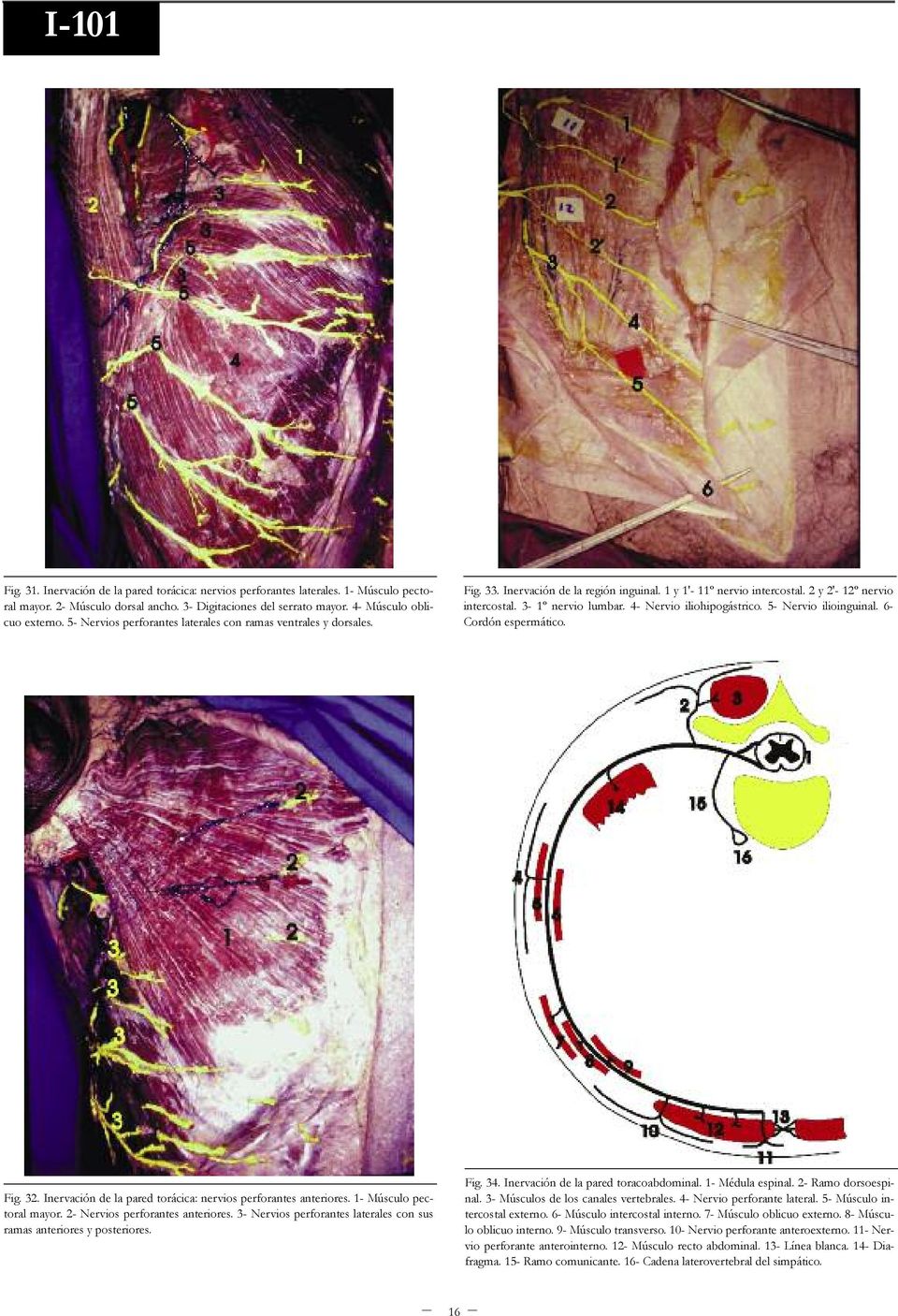 4- Nervio iliohipogástrico. 5- Nervio ilioinguinal. 6- Cordón espermático. Fig. 32. Inervación de la pared torácica: nervios perforantes anteriores. 1- Músculo pectoral mayor.