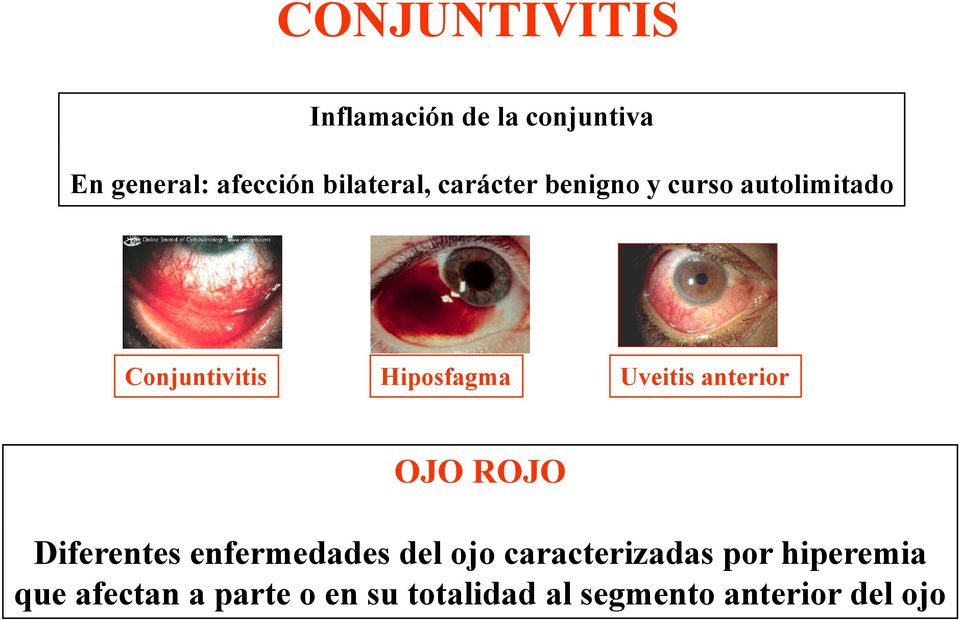 Hiposfagma Uveitis anterior OJO ROJO Diferentes enfermedades del ojo