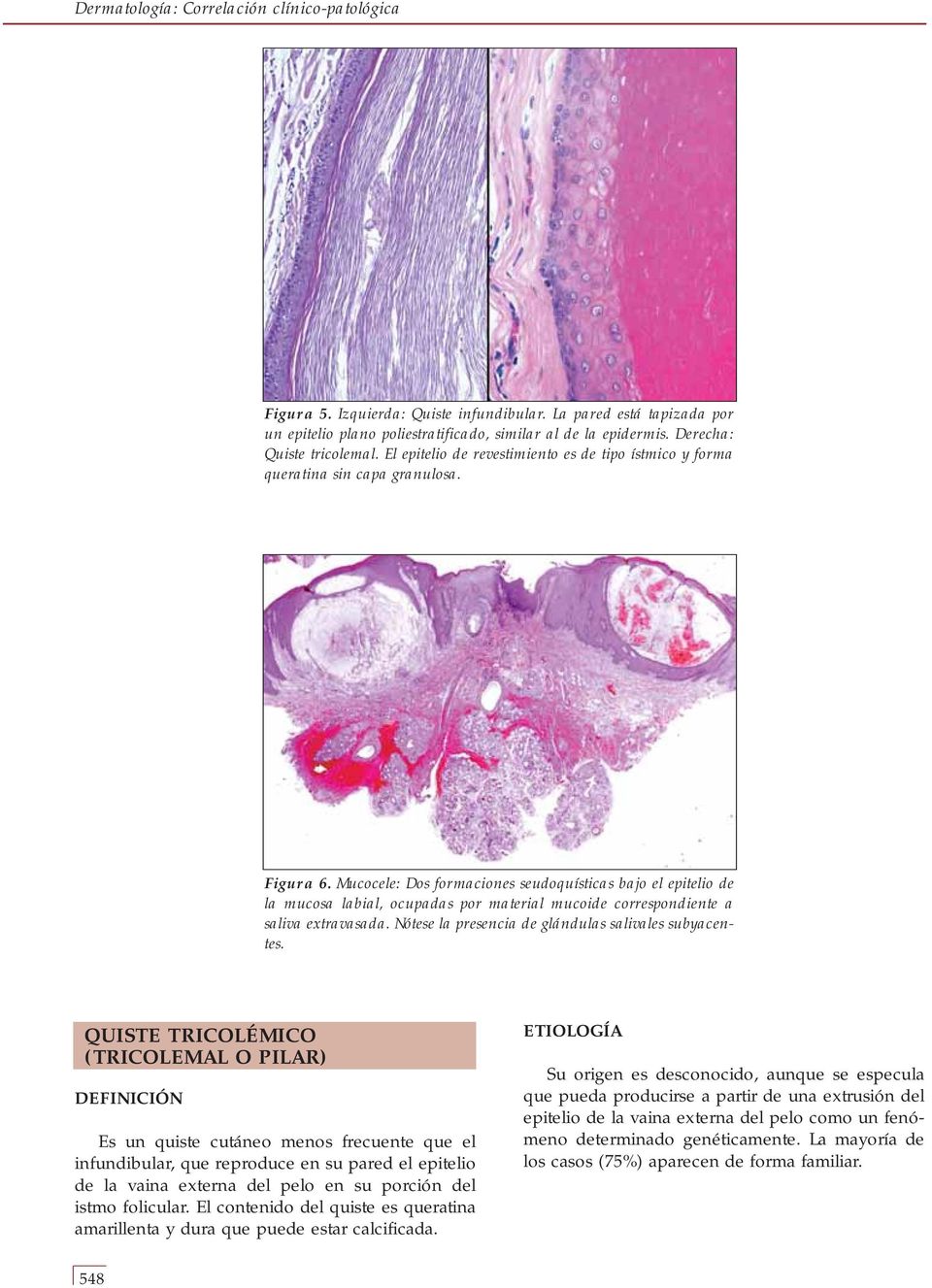 Mucocele: Dos formaciones seudoquísticas bajo el epitelio de la mucosa labial, ocupadas por material mucoide correspondiente a saliva extravasada.
