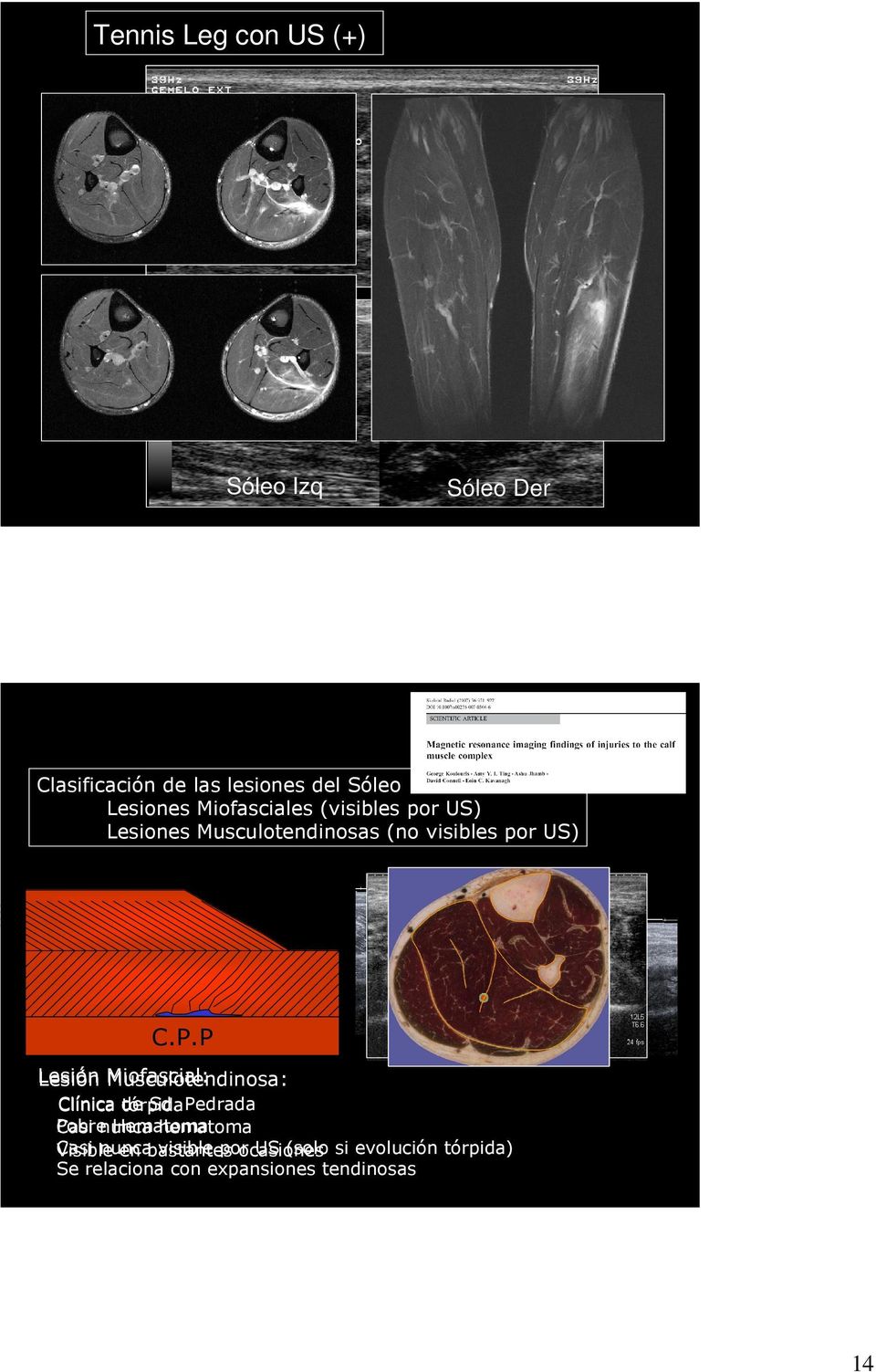 P Lesión Miofascial: Musculotendinosa: Clínica de Sd.