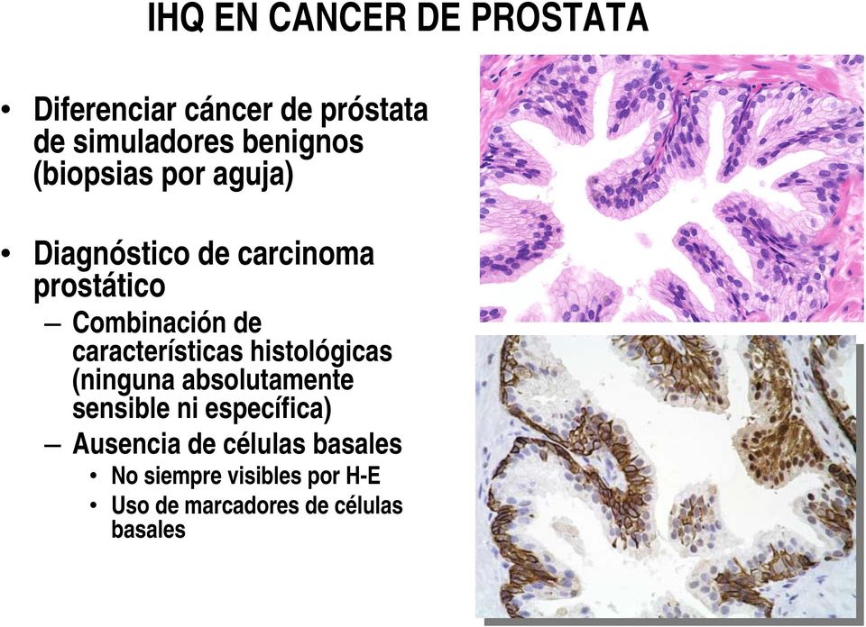 rák 4 fok prosztatitis)