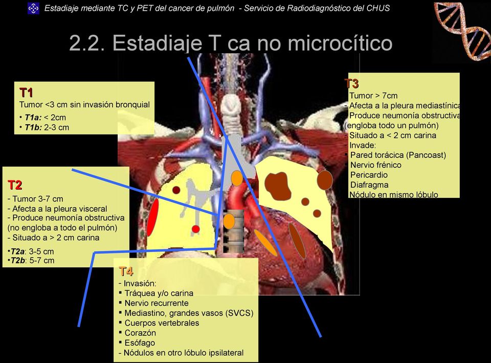 Mediastino, grandes vasos (SVCS) Cuerpos vertebrales Corazón Esófago - Nódulos en otro lóbulo ipsilateral - Tumor > 7cm - Afecta a la pleura mediastínica -