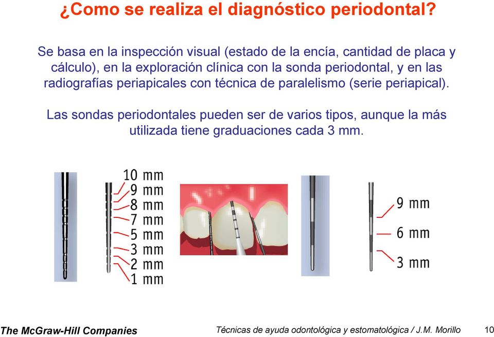 la sonda periodontal, y en las radiografías periapicales con técnica de paralelismo (serie periapical).