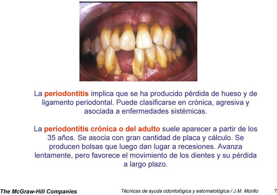 La periodontitis crónica o del adulto suele aparecer a partir de los 35 años. Se asocia con gran cantidad de placa y cálculo.