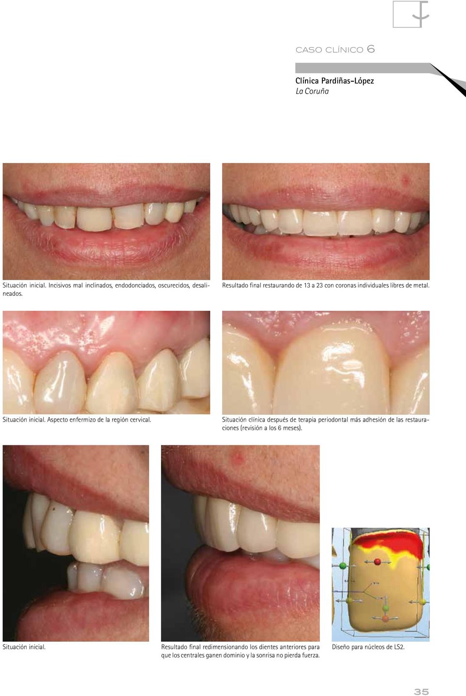 Situación clínica después de terapia periodontal más adhesión de las restauraciones (revisión a los 6 meses). Situación inicial.