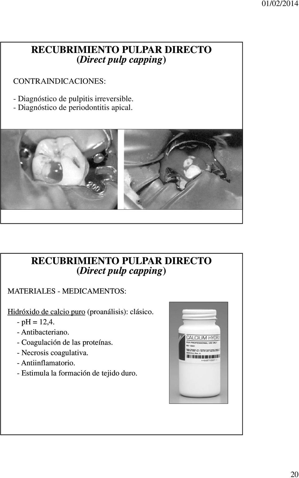 RECUBRIMIENTO PULPAR DIRECTO (Direct pulp capping) MATERIALES - MEDICAMENTOS: Hidróxido de calcio puro