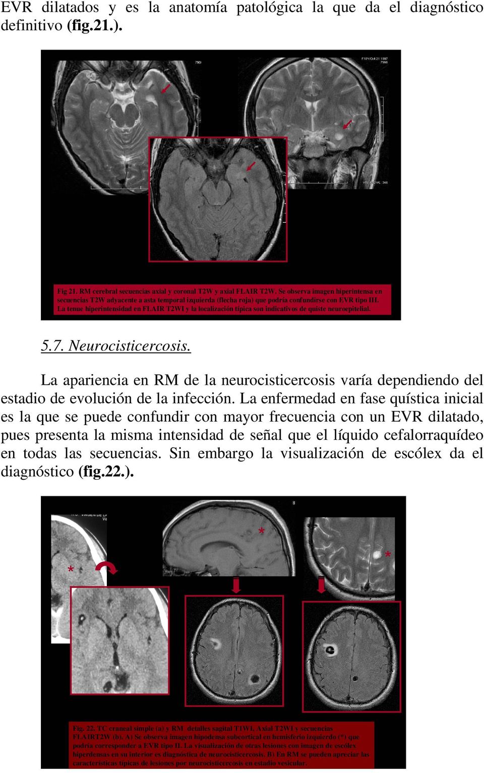 La tenue hiperintensidad en FLAIR T2WI y la localización típica son indicativos de quiste neuroepitelial. 5.7. Neurocisticercosis.