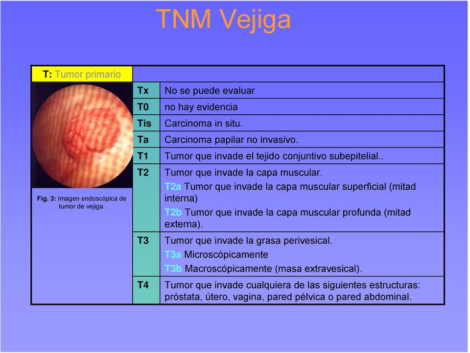 T2a Tumor que invade la capa muscular superficial (mitad interna) T2b Tumor que invade la capa muscular profunda (mitad externa).