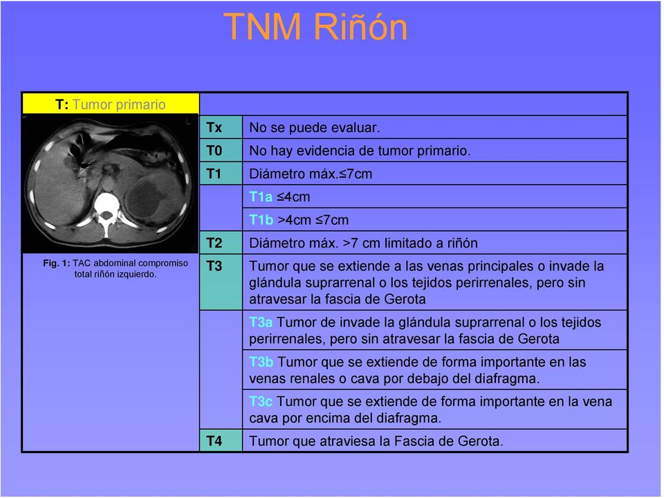 >7 cm limitado a riñón Tumor que se extiende a las venas principales o invade la glándula suprarrenal o los tejidos perirrenales, pero sin atravesar la fascia de Gerota T3a Tumor