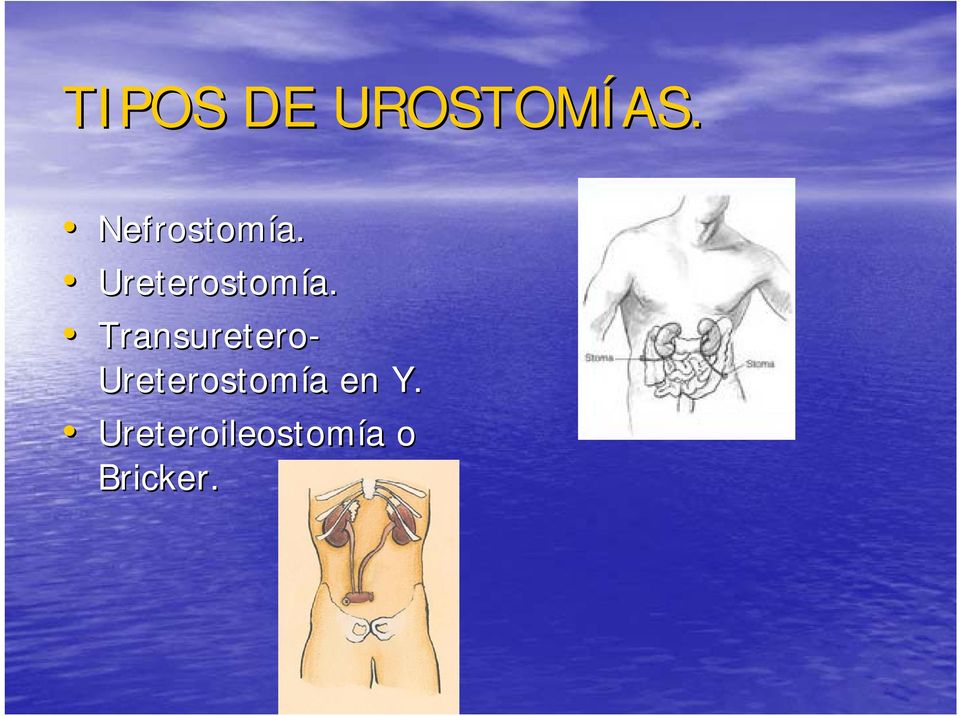Transuretero- Ureterostomía