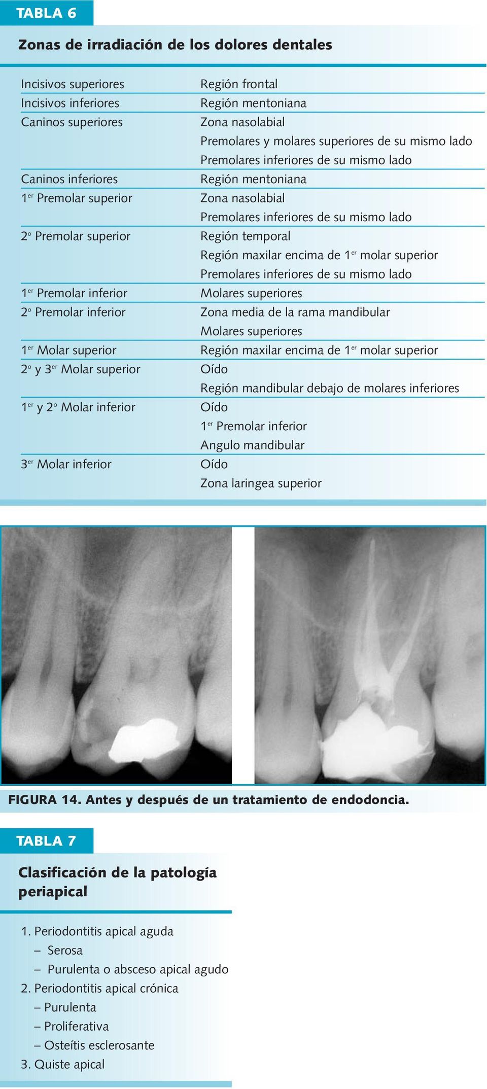 temporal Región maxilar encima de 1 er molar superior Premolares inferiores de su mismo lado 1 er Premolar inferior Molares superiores 2 o Premolar inferior Zona media de la rama mandibular Molares