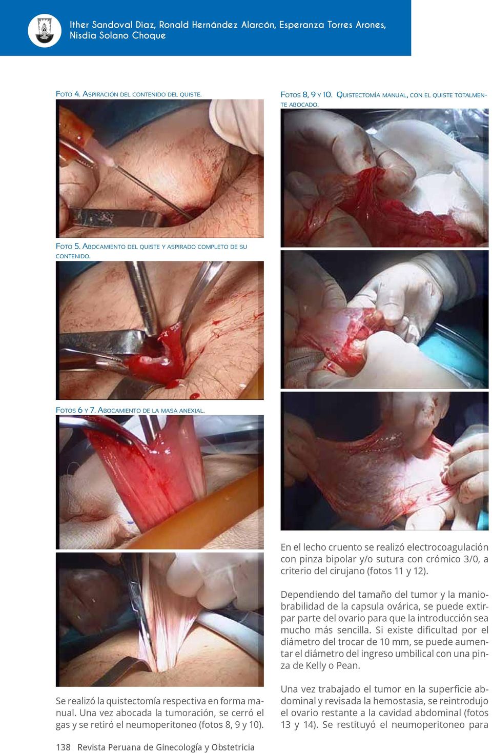 En el lecho cruento se realizó electrocoagulación con pinza bipolar y/o sutura con crómico 3/0, a criterio del cirujano (fotos 11 y 12).