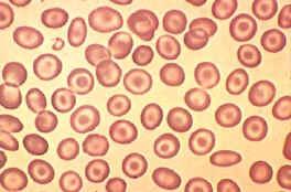 Trastornos del hierro Anemia ferropénica: Es la más común de la anemias y se produce por deficiencia de hierro, el cual es necesario