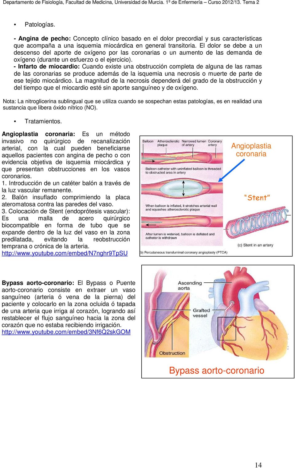 - Infarto de miocardio: Cuando existe una obstrucción completa de alguna de las ramas de las coronarias se produce además de la isquemia una necrosis o muerte de parte de ese tejido miocárdico.