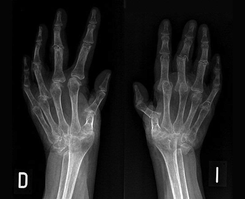 Radiología simple en el paciente reumático con patrón inflamatorio: Artritis Reumatoide o