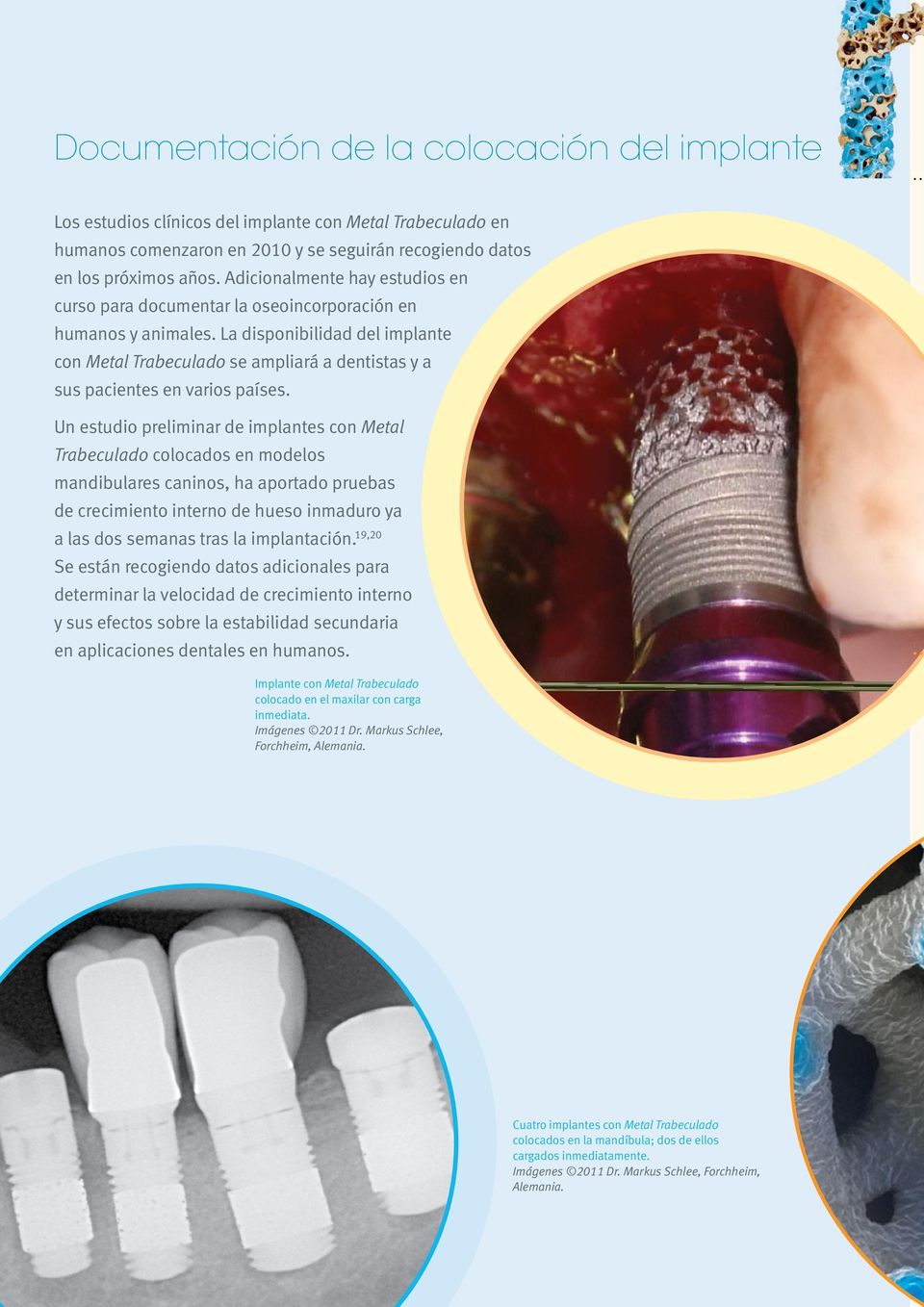 La disponibilidad del implante con Metal Trabeculado se ampliará a dentistas y a sus pacientes en varios países.