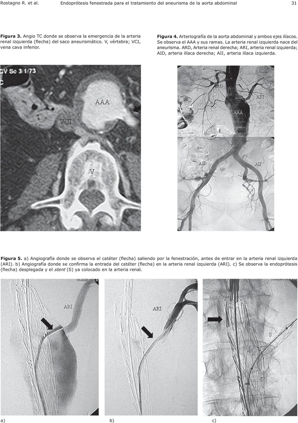Arteriografía de la aorta abdominal y ambos ejes ilíacos. Se observa el AAA y sus ramas. La arteria renal izquierda nace del aneurisma.