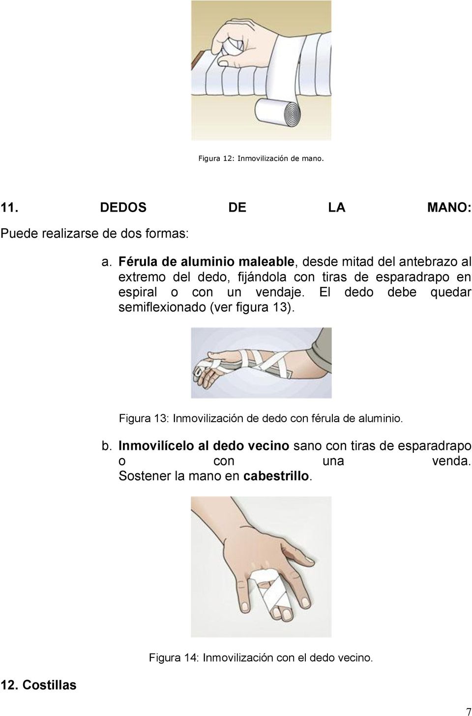 un vendaje. El dedo debe quedar semiflexionado (ver figura 13). Figura 13: Inmovilización de dedo con férula de aluminio. b.
