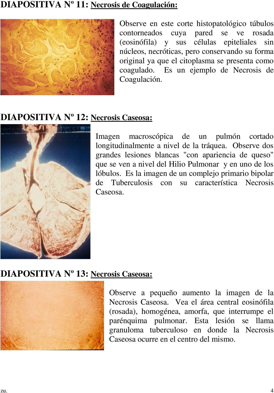 DIAPOSITIVA Nº 12: Necrosis Caseosa: Imagen macroscópica de un pulmón cortado longitudinalmente a nivel de la tráquea.