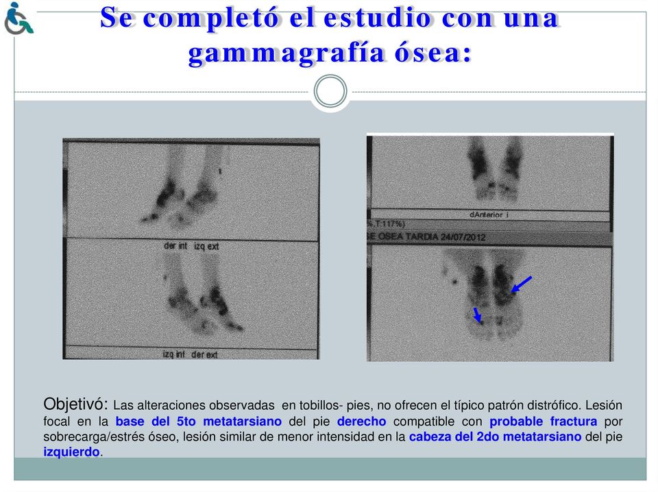 Lesión focal en la base del 5to metatarsiano del pie derecho compatible con probable