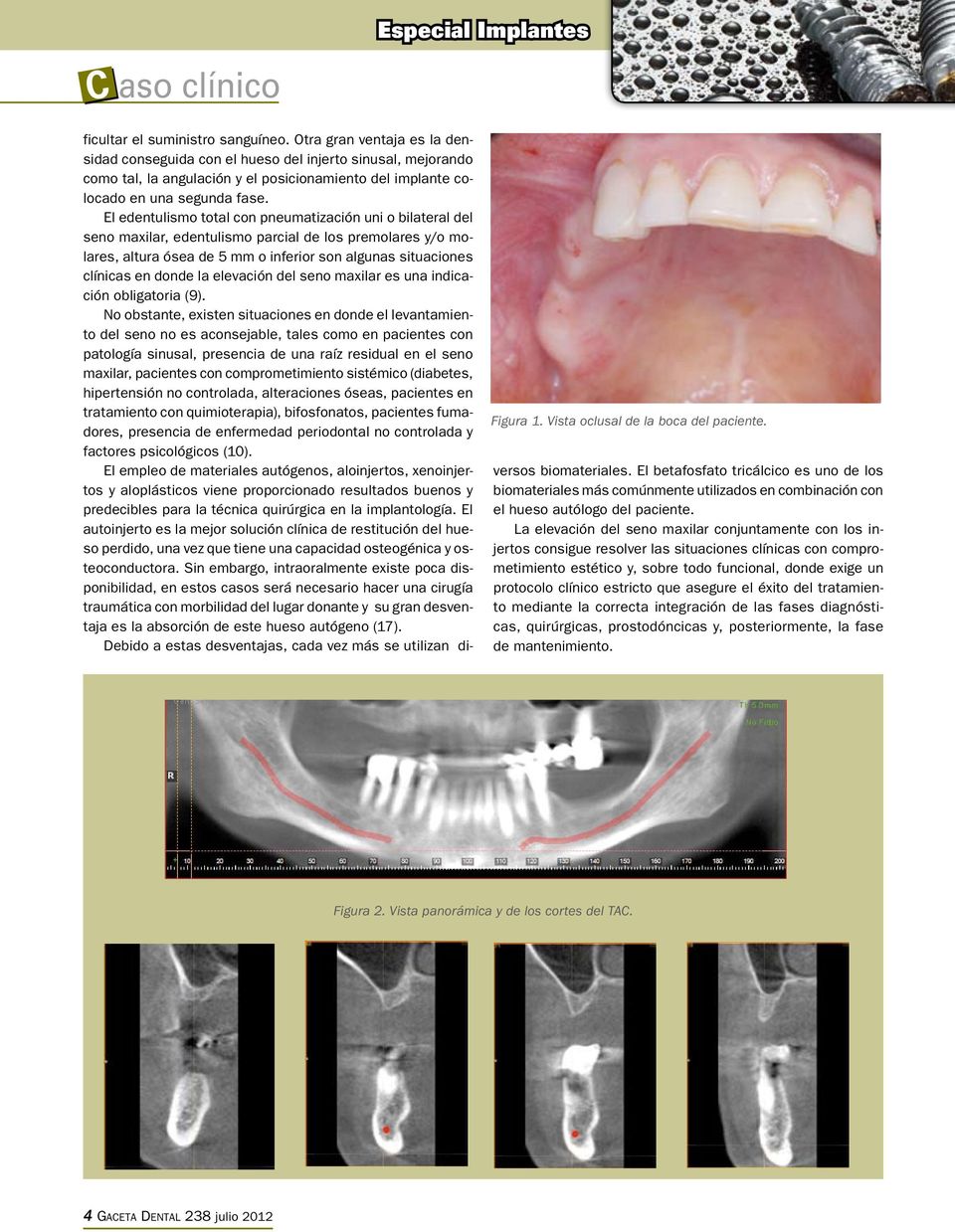 El edentulismo total con pneumatización uni o bilateral del seno maxilar, edentulismo parcial de los premolares y/o molares, altura ósea de 5 mm o inferior son algunas situaciones clínicas en donde