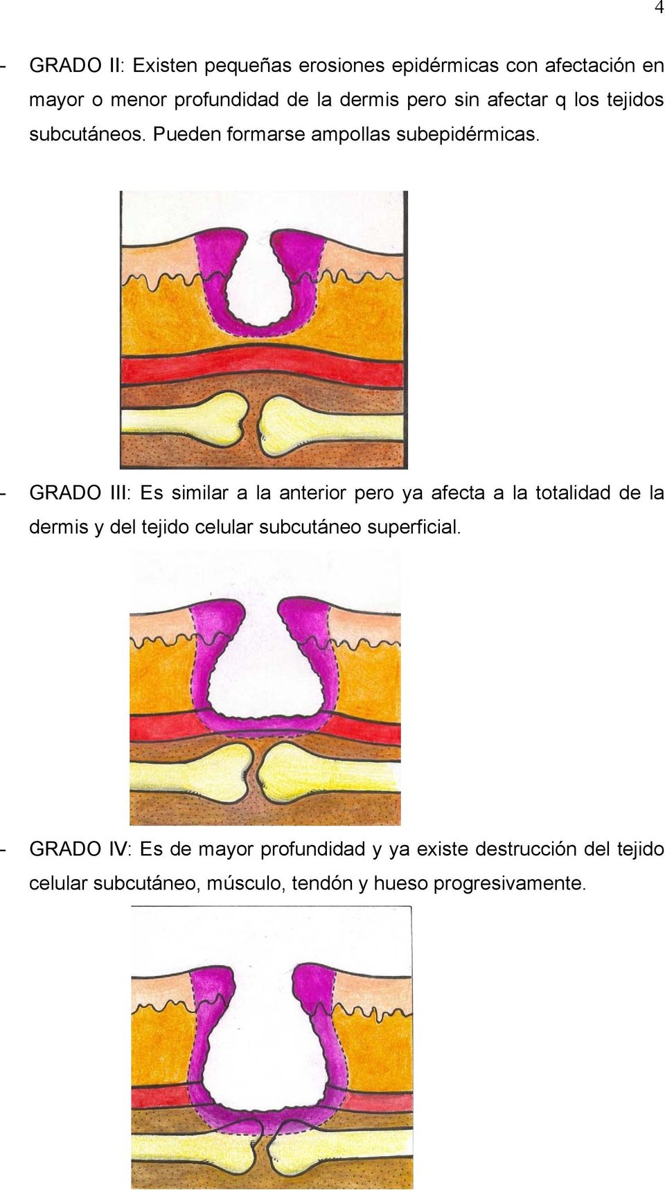 - GRADO III: Es similar a la anterior pero ya afecta a la totalidad de la dermis y del tejido celular subcutáneo