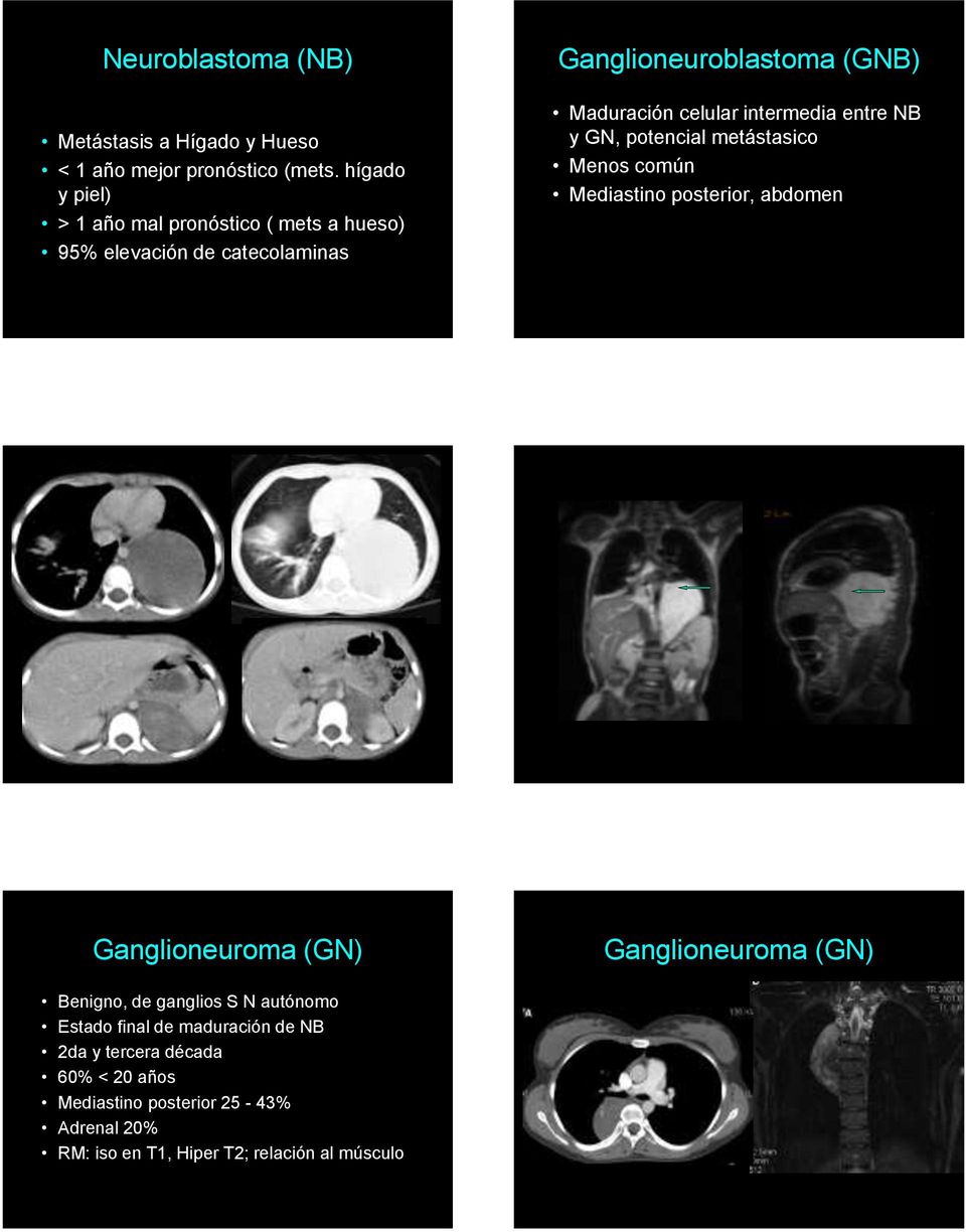 intermedia entre NB y GN, potencial metástasico Menos común Mediastino posterior, abdomen Ganglioneuroma (GN) Ganglioneuroma (GN)
