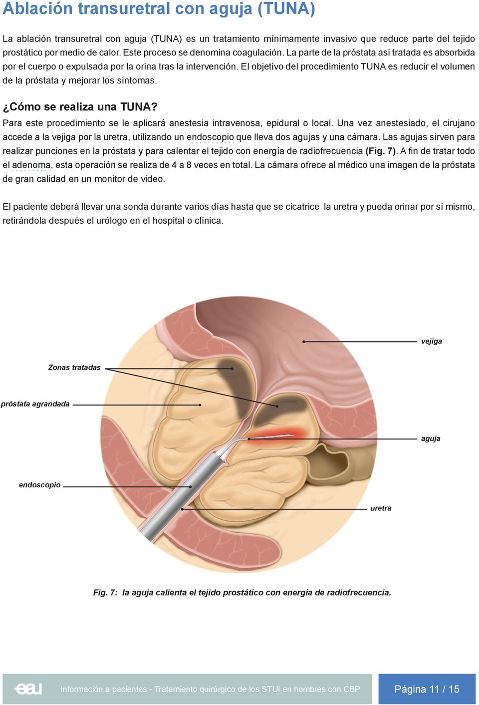 El objetivo del procedimiento TUNA es reducir el volumen de la próstata y mejorar los síntomas. ndoscopio que lleva dos agujas y una cámara.