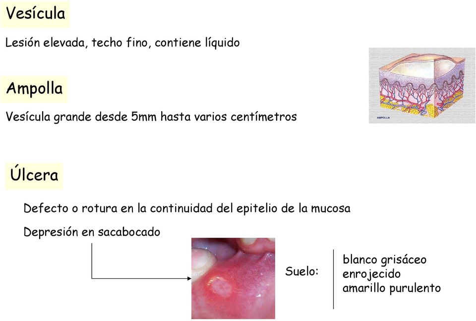 Defecto o rotura en la continuidad del epitelio de la mucosa