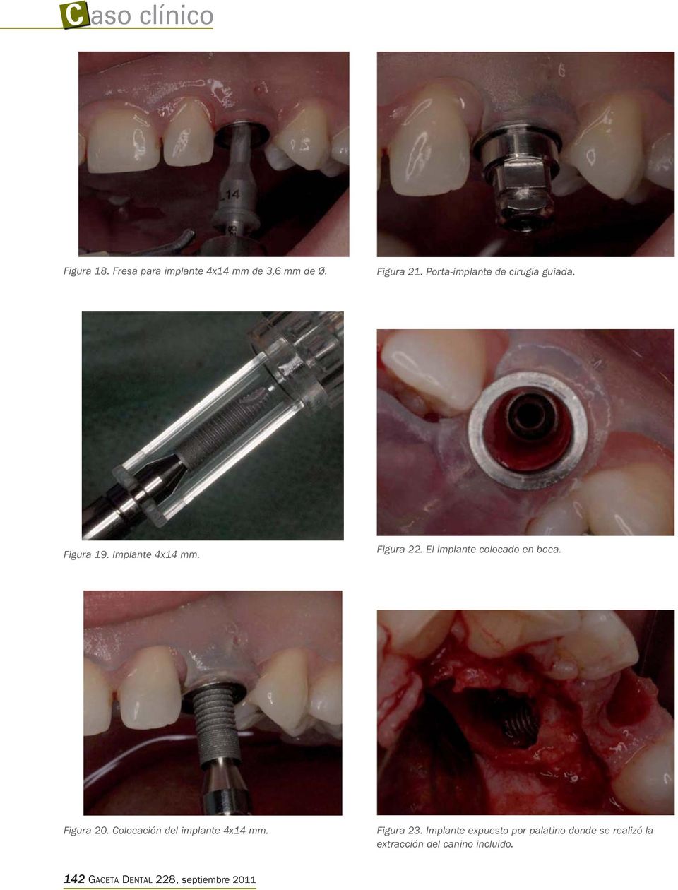 El implante colocado en boca. Figura 20. Colocación del implante 4x14 mm. Figura 23.