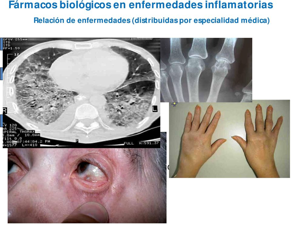Enfermedad de Crohn Colitis ulcerosa REUMATOLOGIA Artritis reumatoide Espondilitis