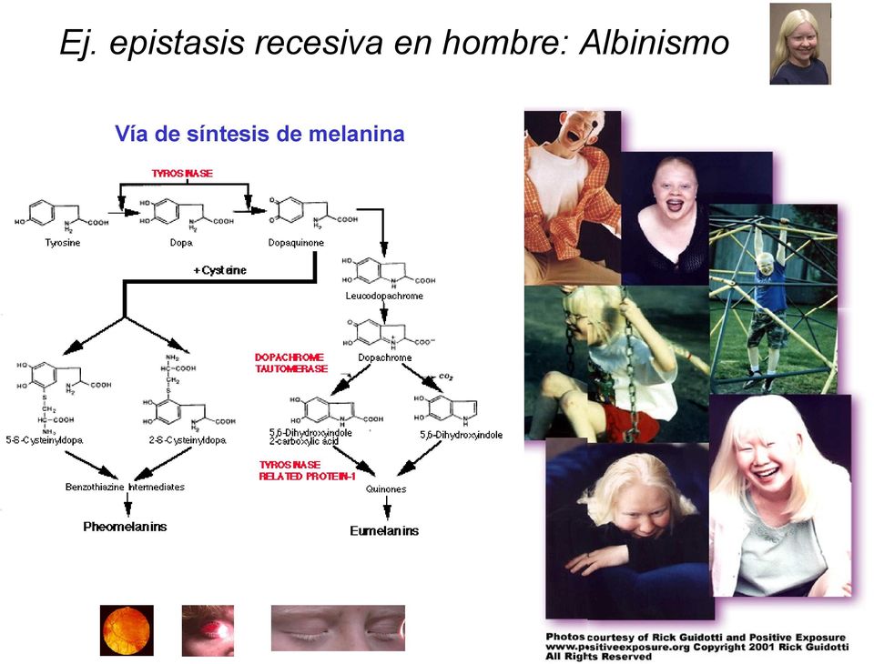 hombre: Albinismo