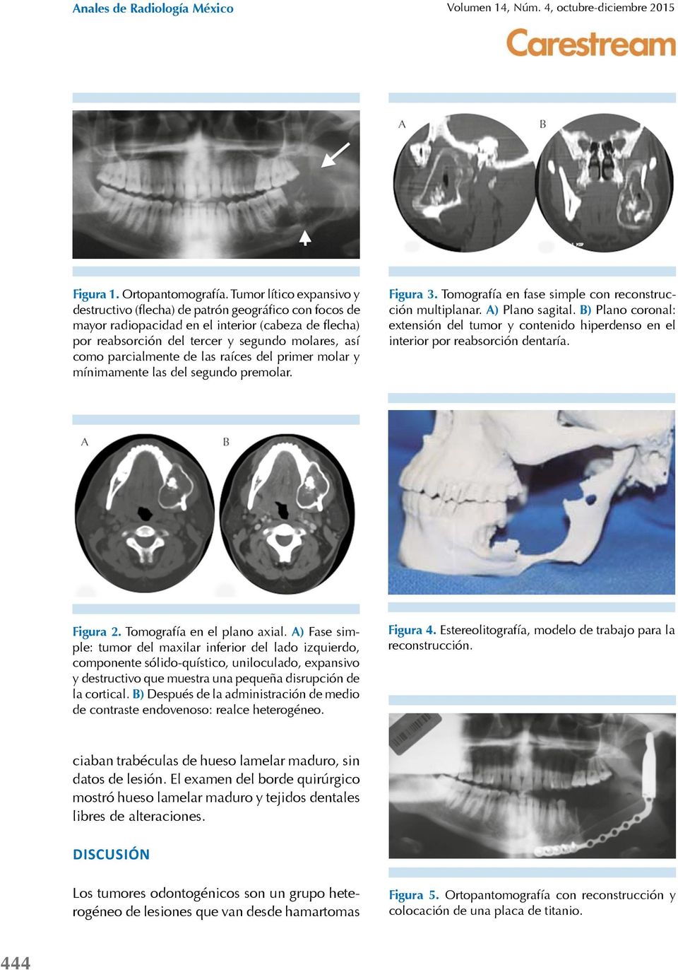 B) extensión del tumor y contenido hiperdenso en el interior por reabsorción dentaría. Figura 2. Tomografía en el plano axial.