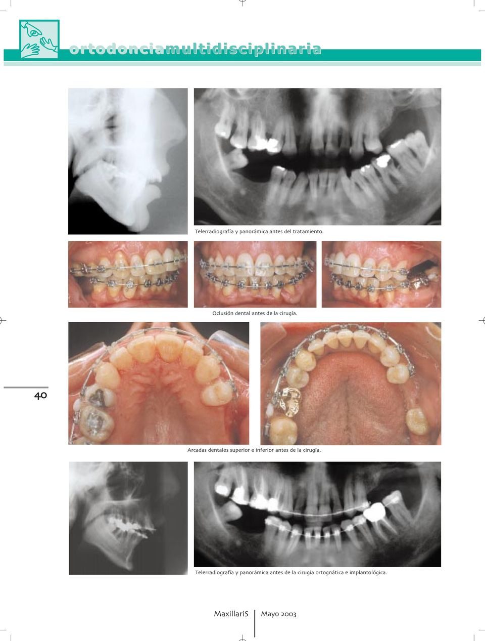 Arcadas dentales superior e inferior antes de la cirugía.