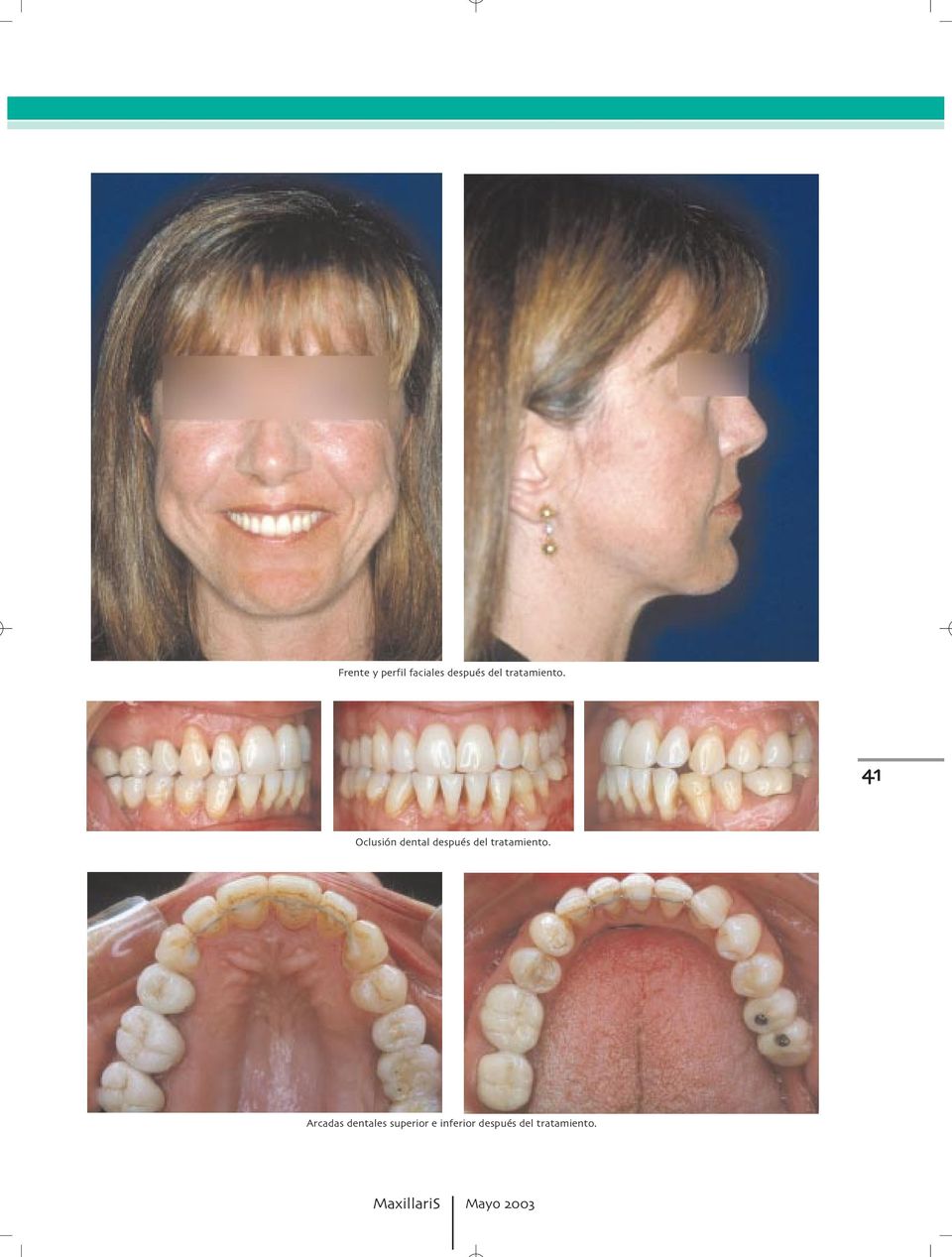 Oclusión dental después del  Arcadas